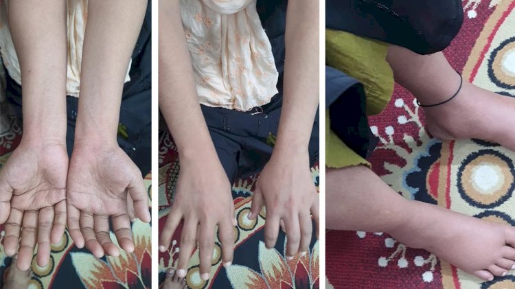 কক্সবাজারে অজানা ভাইরাসে বাড়ছে আতঙ্ক